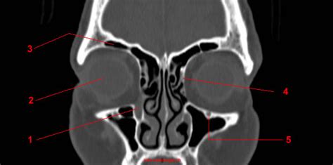 CT of the Orbit: anatomy - W-Radiology