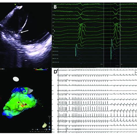 Catheter Ablation For Ventricular Tachycardia A Successful Download Scientific Diagram