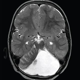 Axial T A And Sagittal T B Mri Scans Show Hypoplasia Of The