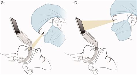 Illustrations Showing How To Use The Mcgrath Videolaryngoscope As A Download Scientific Diagram