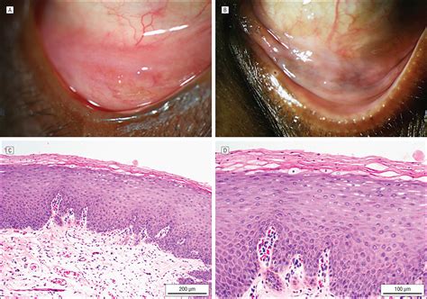 Squamous Metaplasia Of The Conjunctiva A Previously Unrecognized Adverse Effect Of Risedronate