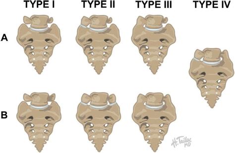 Transitional vertebrae as classified by Castellvi et al. 5 Type I has a ...