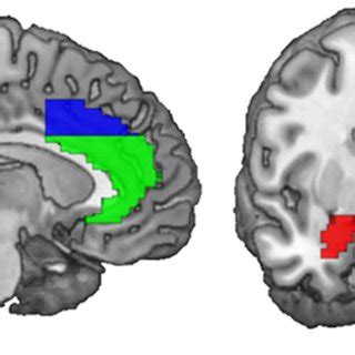 (PDF) Predicting cognitive behavioral therapy response in social anxiety disorder with anterior ...