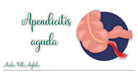 Apendicitis Aguda Anjhela Andrea Andia Tello UDocz