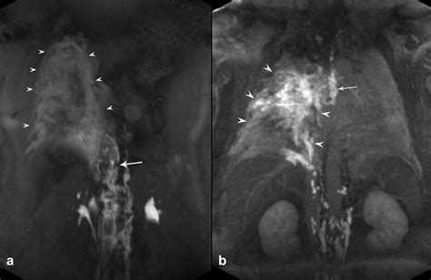 Dynamic Contrast Enhanced Magnetic Resonance Lymphangiography And