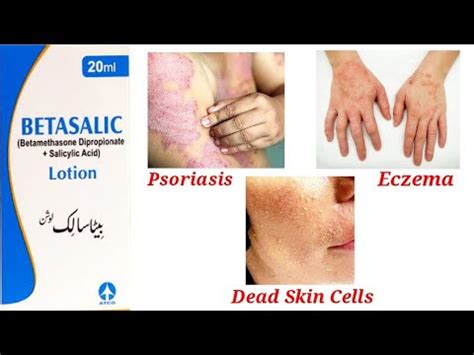 Betasalic Lotion Uses In Urdu Youtube