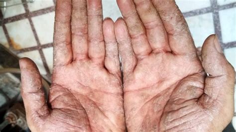 Palmar And Plantar Psoriasis Diagnosis Treatment And More