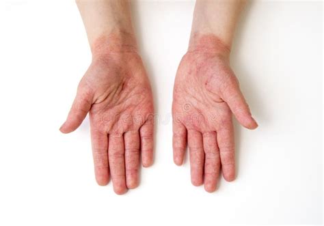 Dermatite Dans Des Mains Photo Stock Image Du Dermatologie