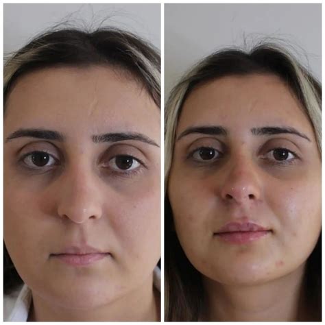 izmir buca da botox işlemi yapan uzman doktor googlereklamcim