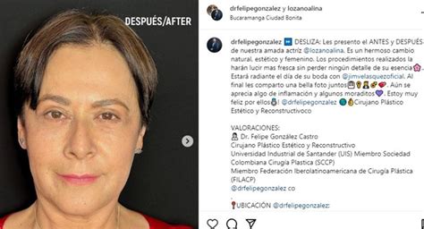 Alina Lozano ya mostró su impresionante cambio después de su cirugía