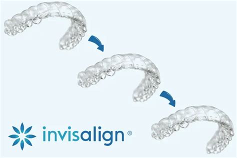 Alinhador Transparente Invisalign Implart Implantes