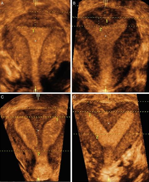 Partial Septate Uterus Ultrasound