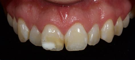 Tooth Discoloration Types Of Tooth Discoloration Nha Khoa Bedental