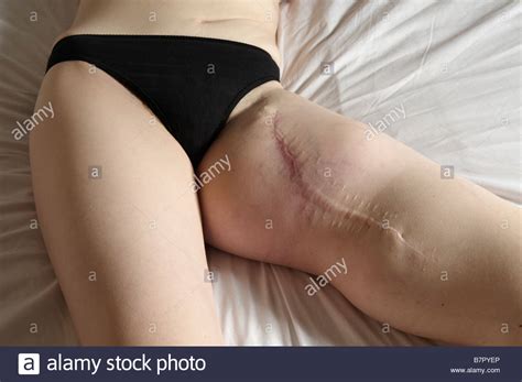 Sarcoma Leg Hi Res Stock Photography And Images Alamy