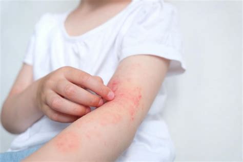 What Causes Atopic Dermatitis In Adults Seacoast Dermatology Dermatology Clinic