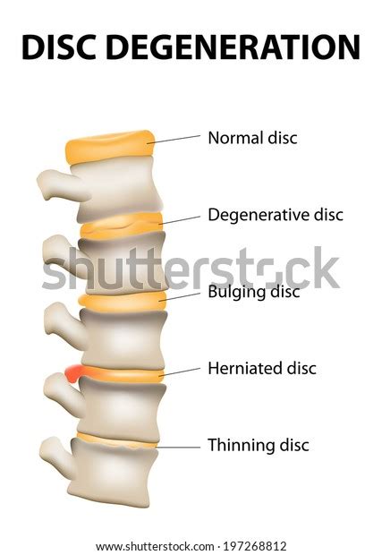 Inter Vertebral Disc Disease Photos and Images & Pictures | Shutterstock