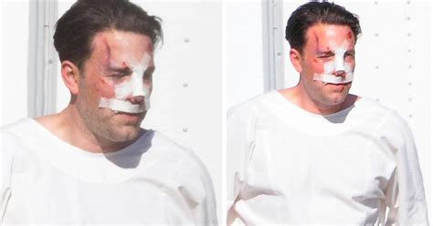 La Impactante Foto De Ben Affleck Ensangrentado Y Con Vendas En El