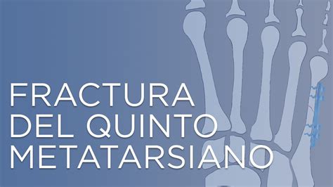 Todo Lo Que Necesitas Saber Sobre La Recuperaci N De La Fractura Del