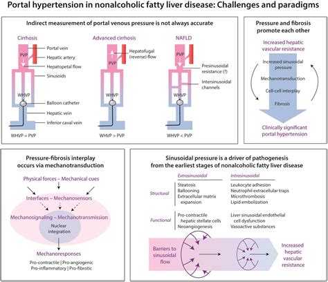 portal hypertension  nonalcoholic fatty liver disease challenges