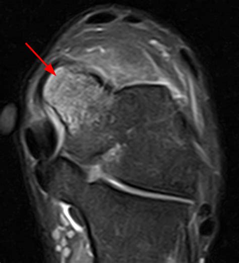 16c Hypertrophied Talar Ridge Causing Anteromedial Ankle Impingement