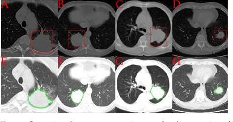 Figure 2 From Automated Classification Of Lung Cancer Subtypes Using Deep Learning And Ct Scan