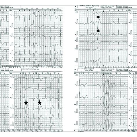 Holter Electrocardiogram Of The Patient Demonstrated Sinus Rhythm With