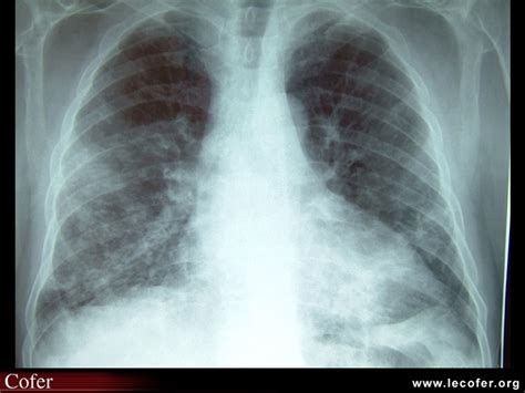 Radiographie Infiltrat Pulmonaire Diapoth Que Du Cofer