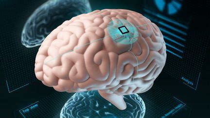 La course aux implants dans le cerveau pour contrôler les machines par