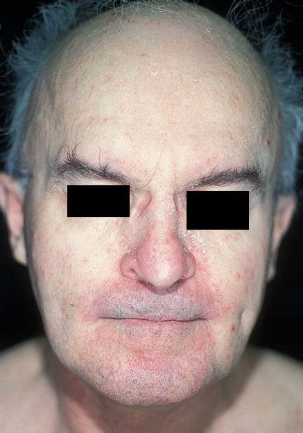 Seborrheic Dermatitis