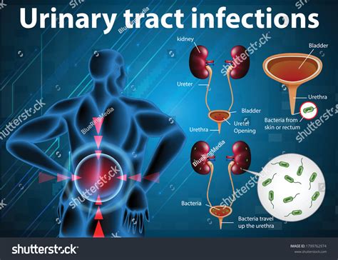 Informative Illustration Urinary Tract Infections Illustration Stock