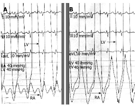 Hemodynamic Tracing During Catheterization A Right Atrial Ra