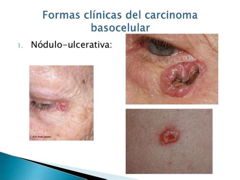 Carcinoma Basocelular Y Espinocelular