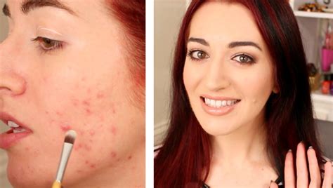 How To Cover A Pimple Mild Acne Scarring Makeup Tutorial For Acne