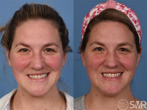 Bells Palsy Before And After Photo Gallery Dallas Tx Shai M Rozen Md Facs