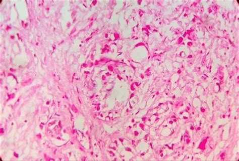 Signet Ring Cell Morphology With Eccentric Nucleus Pas Stain 400x