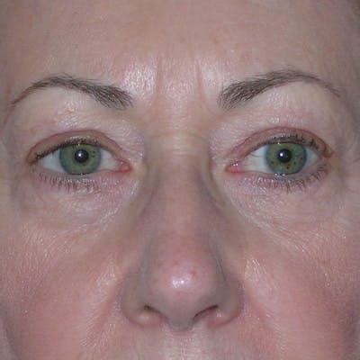 Upper Eyelid Surgery Before & After Photos | Dr. Torkian, MD