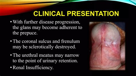 Balanitis Xerotica Obliterans Bxo Penile Lichen Sclerosis Ppt