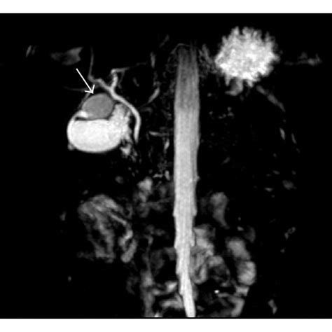 Cystic Dilatation Of The Cystic Duct Was Determined In Coronal Mrcp And