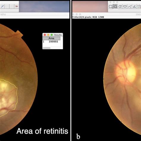 Optical Coherence Tomography Parameters At Final Visit A OCT Image