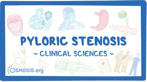 Pyloric stenosis: Clinical sciences - Osmosis Video Library