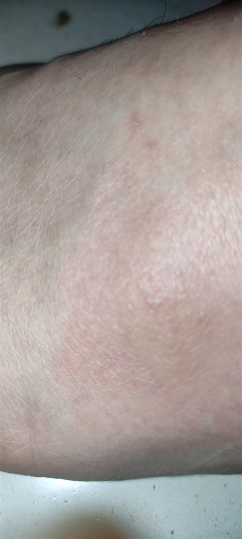 Water Blisters forming from red itchy bumps : r/DermatologyQuestions