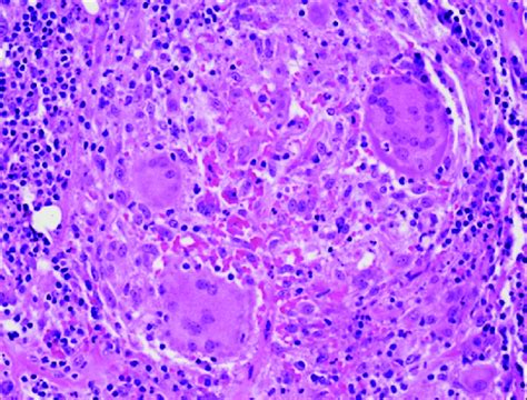 Pathology Slide Demonstrating Changes Consistent With Idiopathic