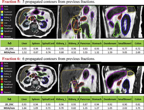 A Patient Specific Autosegmentation Strategy Using Multi Input