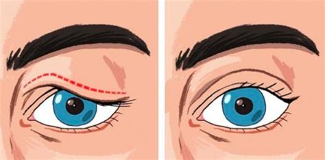 Palpebre Cadenti 3 Rimedi Naturali Per Alzarle E Ringiovanire Gli
