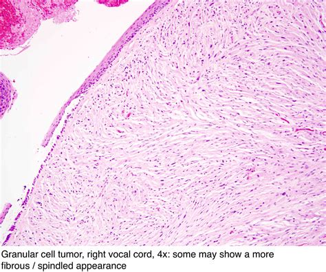 Pathology Outlines Granular Cell Tumor