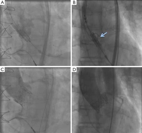 Aortic Root Angiogram During Implantation Of A Sapien Xt A And C And