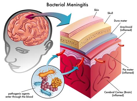 Bacterial Meningitis : Overview, Causes, Symptoms, Treatment - illness.com