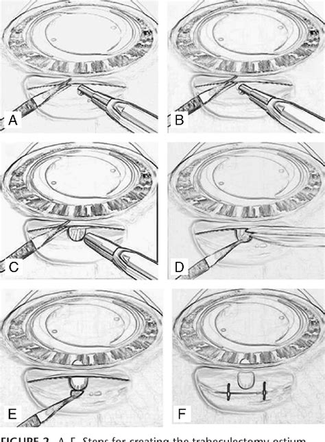 Trabeculectomy Steps