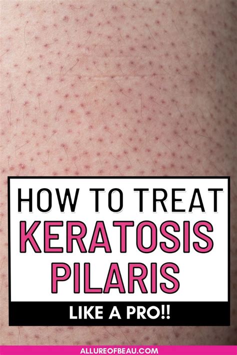 How To Get Rid Of Keratosis Pilaris Fast Artofit