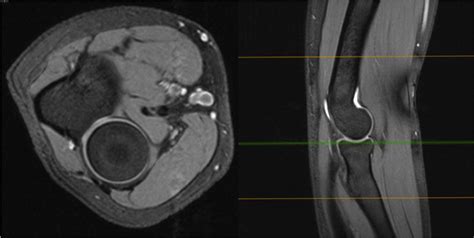 Contribution Of Cartilage To Size And Shape Of Radial Head